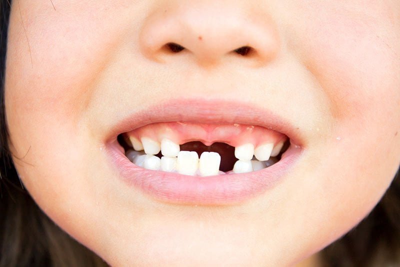kid-missing-teeth