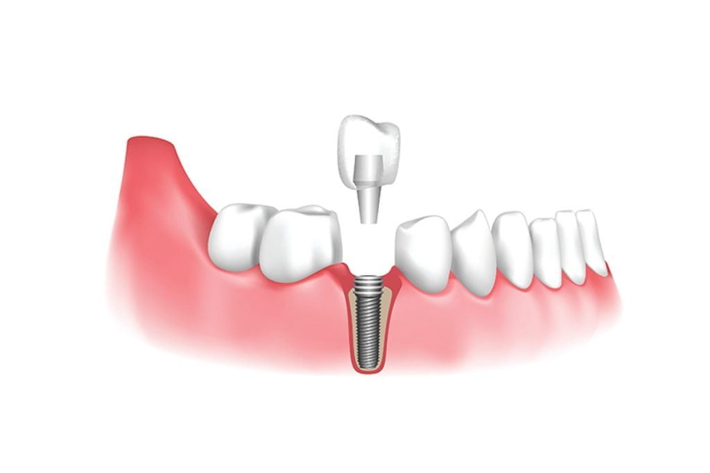 What-are-Dental-Implantstrrrrf-1