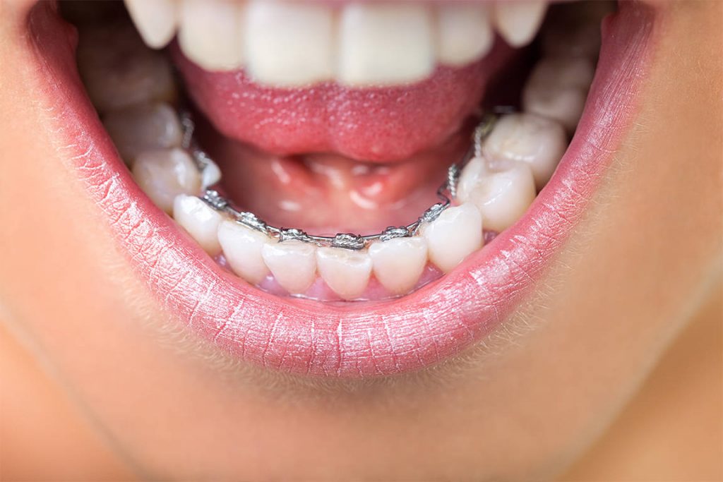 other-terminology-used-for-lingual-braces-dr-geoffrey-wexler-orthodontist-frankston-toorak-1024x683-1