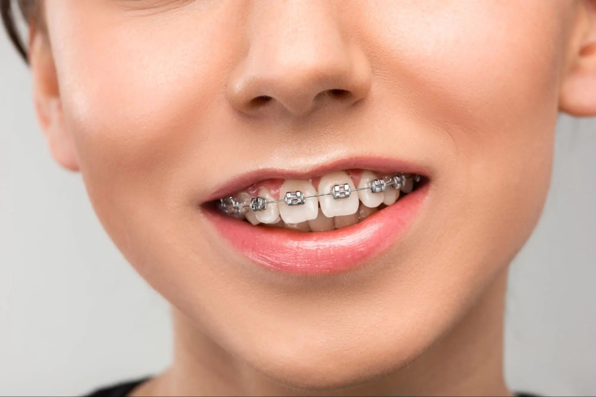 People with gaps between their teeth can get invisalign treatment
