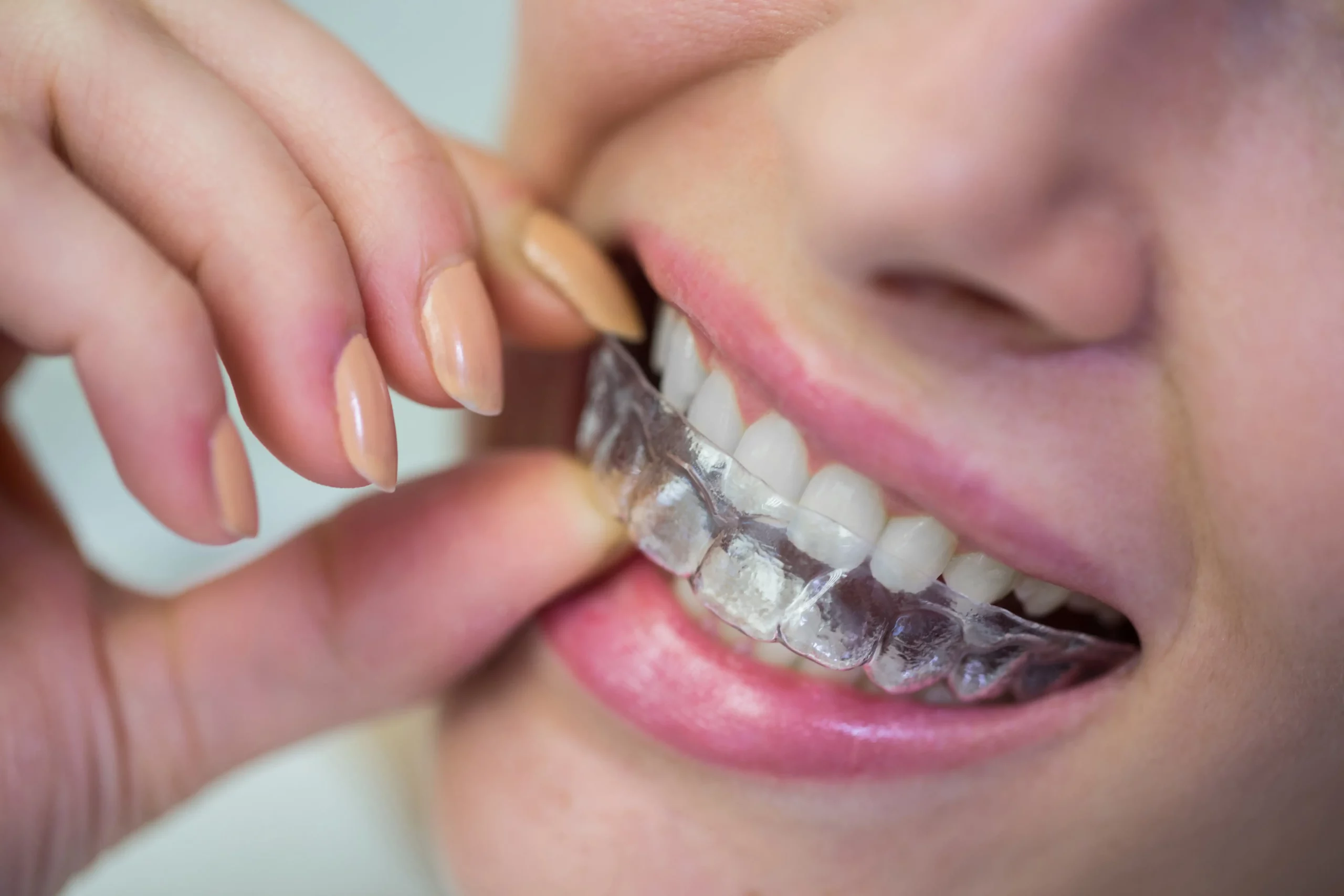 Teens and adults with mild to moderate teeth misalignment can get invisalign treatment