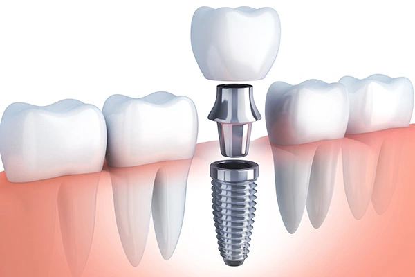 dental implants in Hyderabad