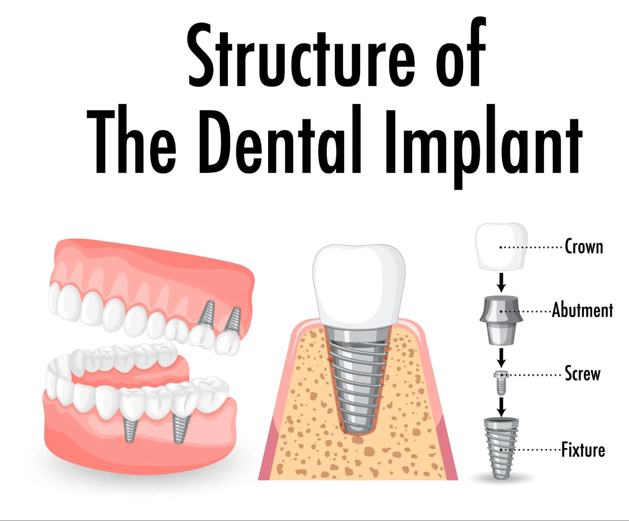 structure of dental implants